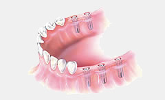 dental implant treatment 6