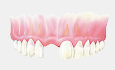 dental implant treatment 3