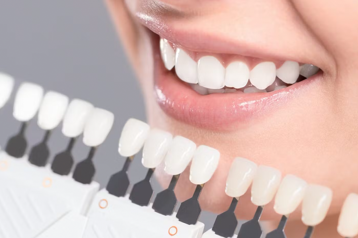 Cosmetic Dentistry Shades