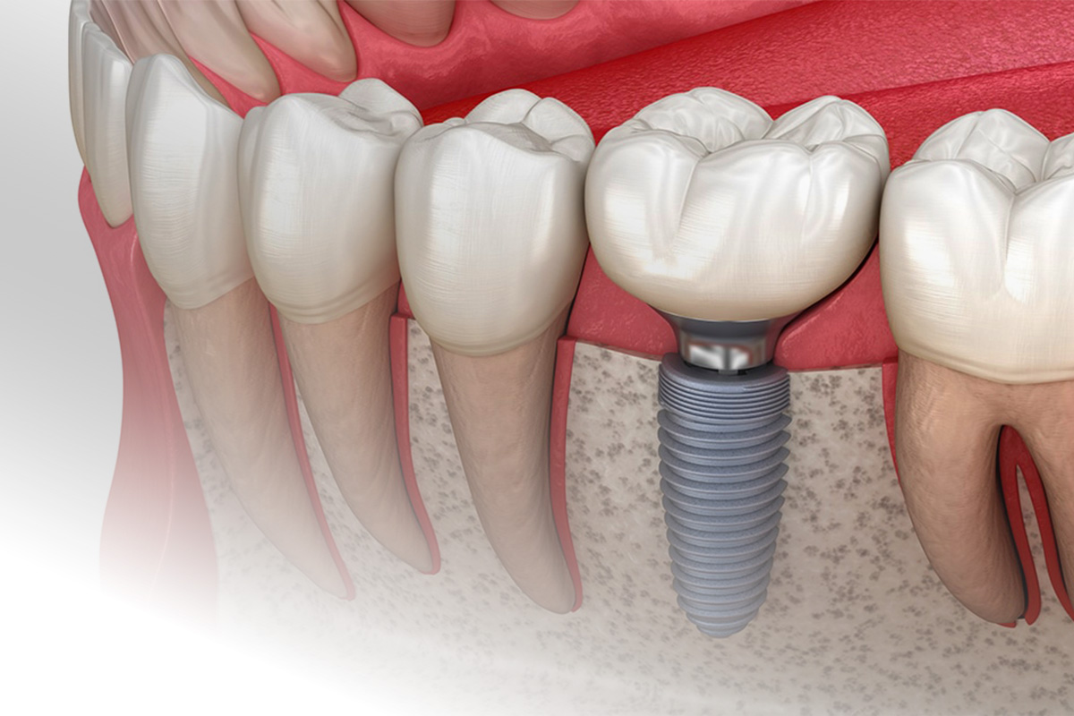 dental-implant-treatment