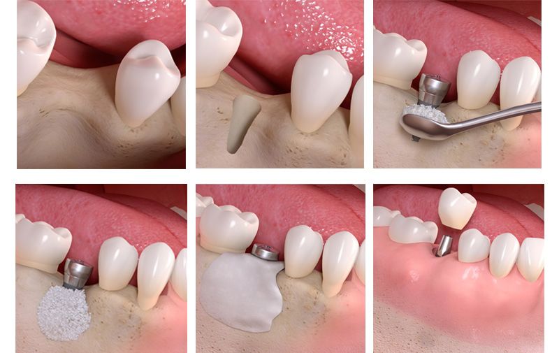 how dental implant treatment done in Turkey