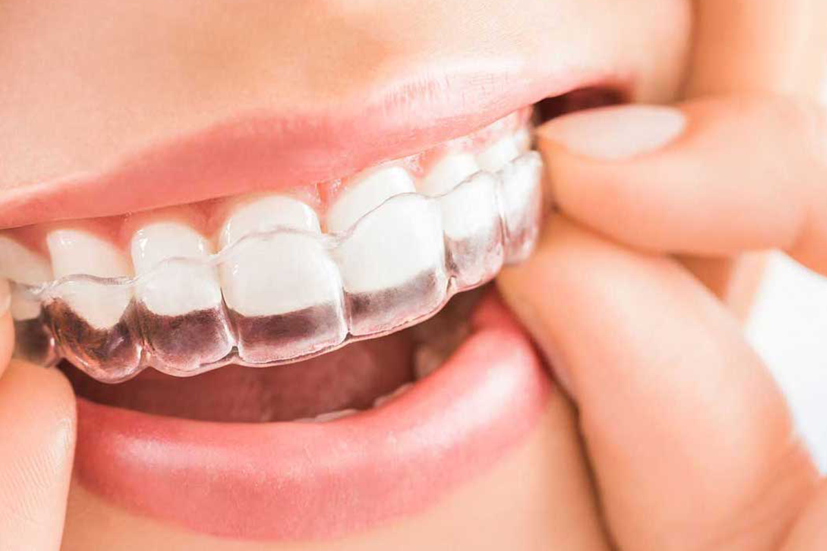 aligner-treatment-in-turkey