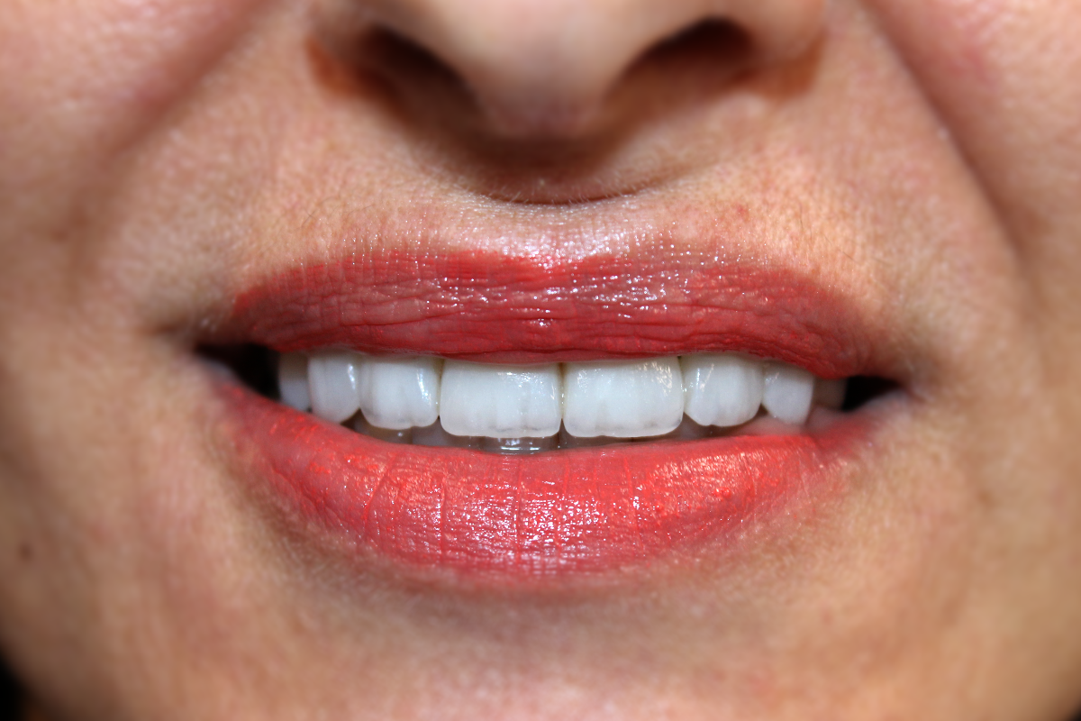 Laminate Veneers Uzmanlar Dental Clinic Istanbul Turkey