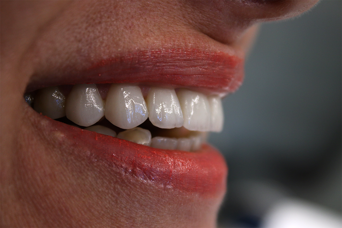 Laminate Veneers Uzmanlar Dental Clinic Istanbul Turkey