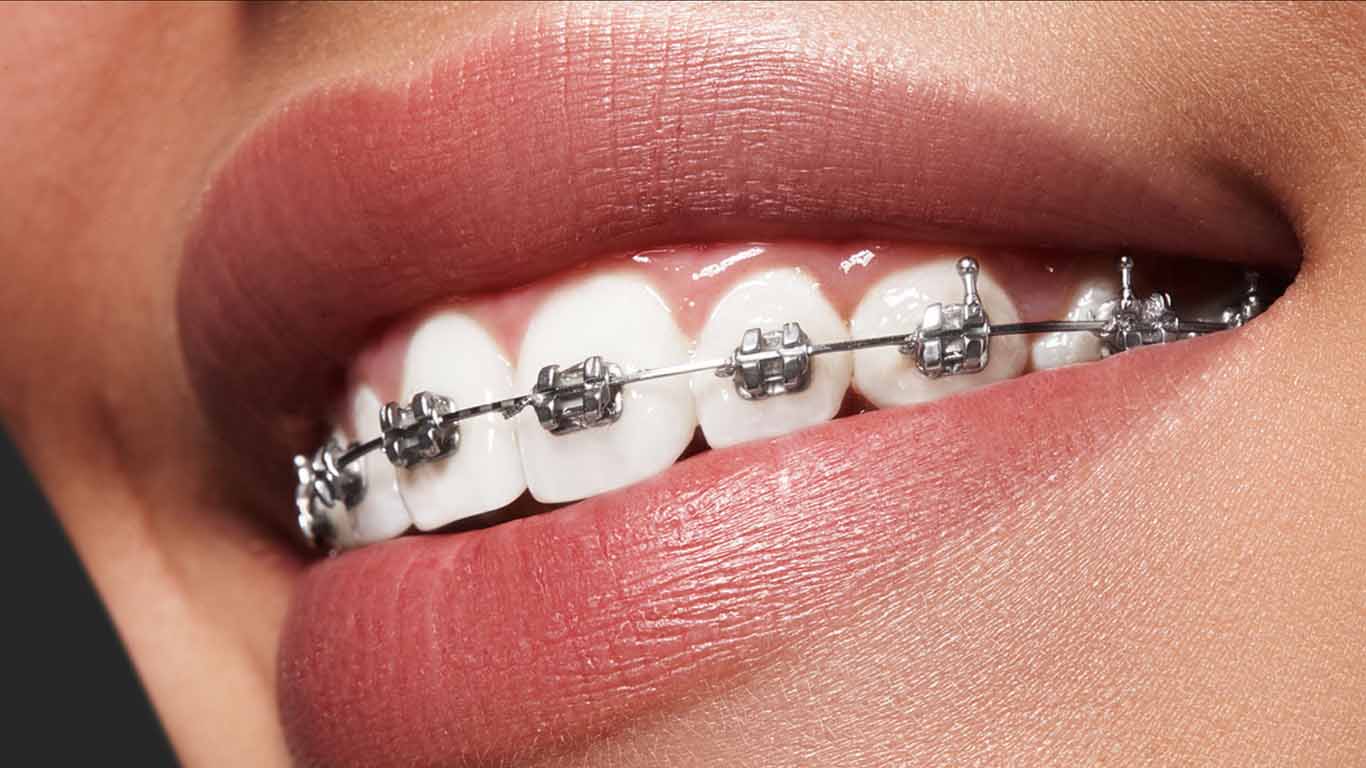 fixed-braces